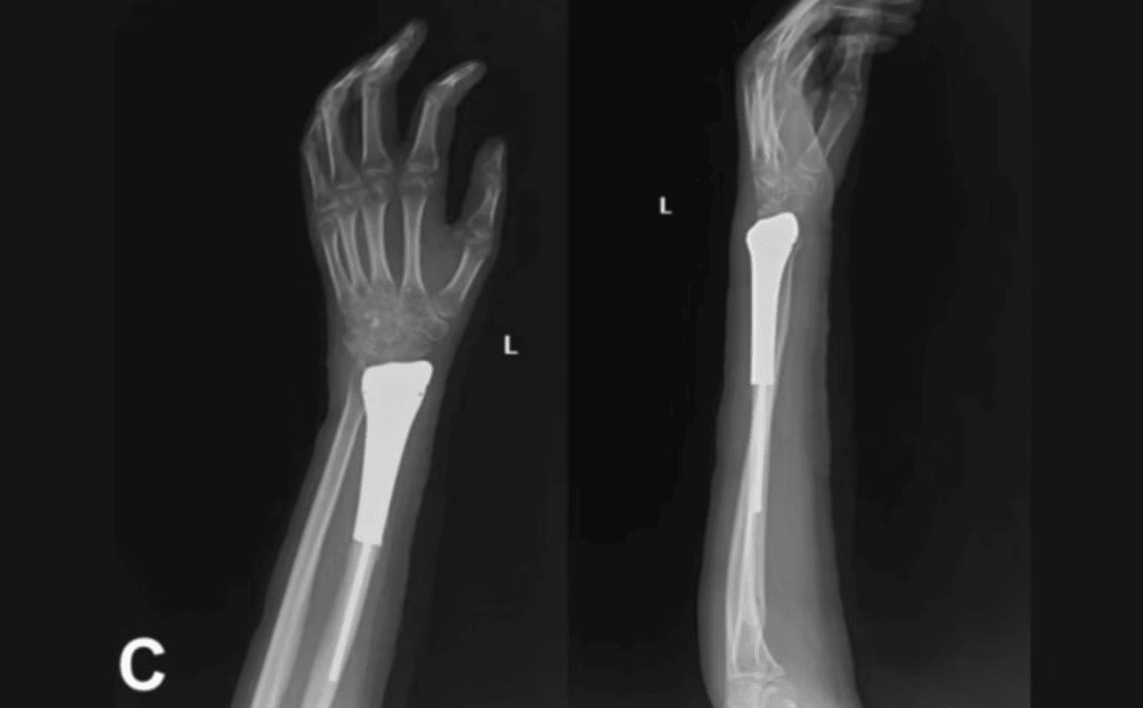 3d-printed-titanium-restores-wrist-function