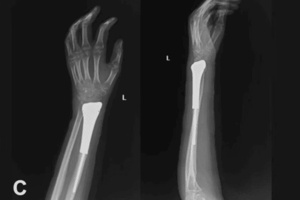 3D Printed Titanium Restores Wrist Function