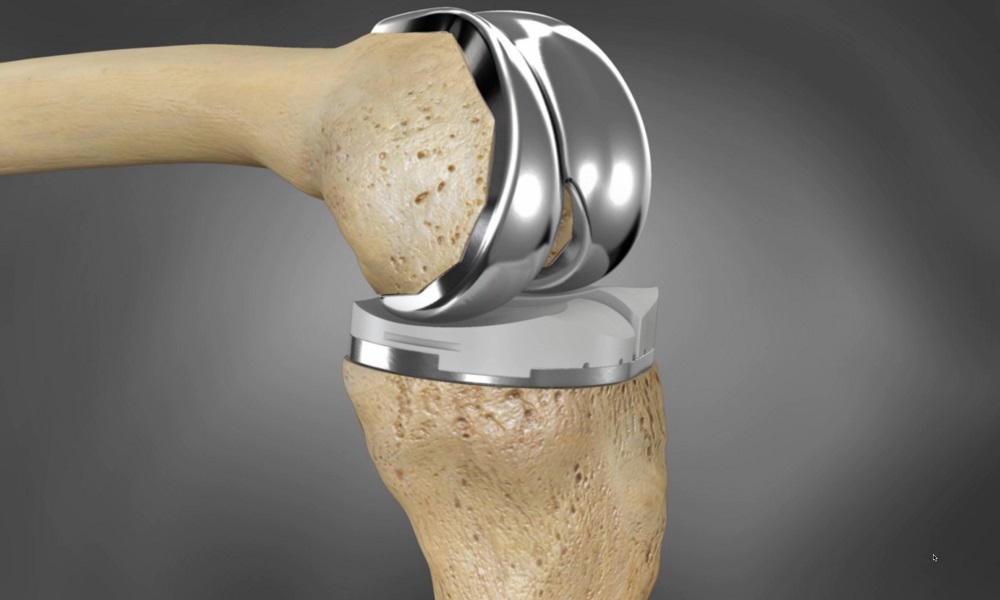 3D Printed Implant for Knee