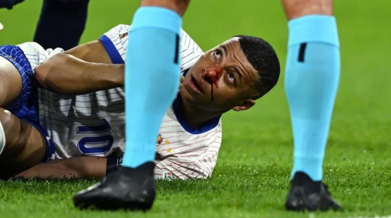 Kylian Mbappe Suffered Broken Nose vs. Austria